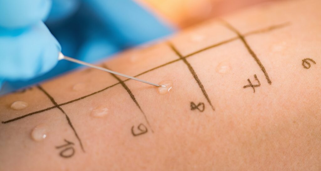 What Are the Benefits of a Skin Prick Test?