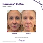 Harmony XL Before and After Photo - Dye-VL, ClearLift