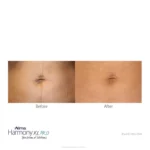 Harmony XL Before and After Photo - Scar Removal
