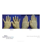 Harmony XL Before and After Photo - Hands