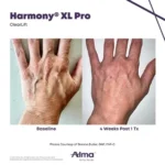 Harmony XL Before and After Photo - ClearLift Butler