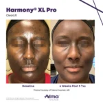Harmony XL Before and After Photo - Clearlift Grayman