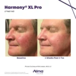 Harmony XL Before and After Photo - LD Nd:YAG