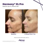 Harmony XL Before and After Photo - Clearlift DyeVL