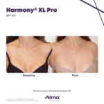 Harmony XL Before and After Photo - AFT 570