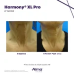 Harmony XL Before and After Photo - LP Nd:YAG