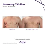 Harmony XL Before and After Photo - ClearLift iPixel