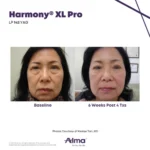 Harmony XL Before and After Photo - LP Nd:YAG
