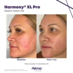 Harmony XL Before and After Photo - ClearLife iPixel 2