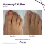 Harmony XL Before and After Photo - ClearLift