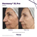Harmony XL Before and After Photo - ClearLift Moise