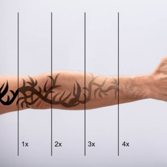 Laser Tattoo Removal in Greenville, SC​