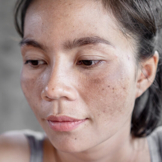 Melasma Treatment in Greenville, SC​
