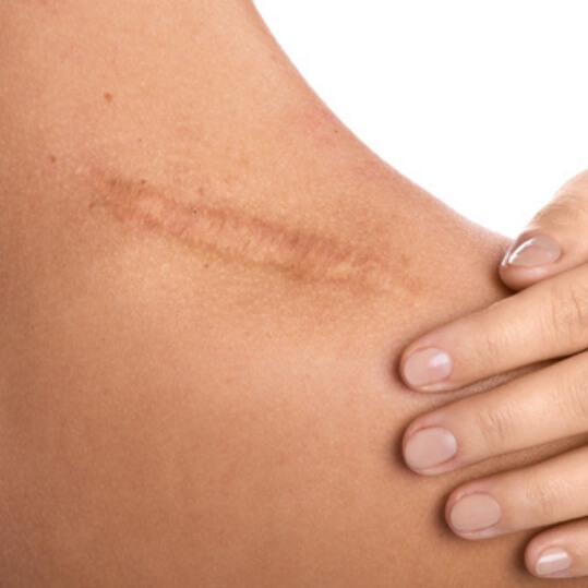 laser scar treatment in Greenville, SC​