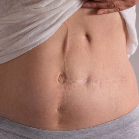 scar revision in Greenville, SC​