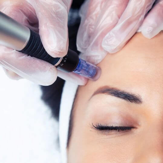 Microneedling Services in Greenville, SC